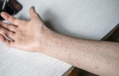 Cara Penanggulangan Jika Bertemu Orang Terinfeksi Campak, Viral Influencer Diduga Tularkan di Tempat Umum