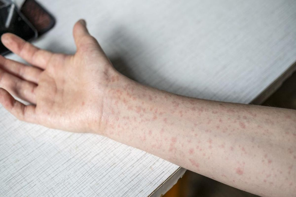 Cara Penanggulangan Jika Bertemu Orang Terinfeksi Campak, Viral Influencer Diduga Tularkan di Tempat Umum