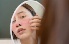Kasus Lupus di Jakarta Terus Naik, Pemprov DKI Fokus Skrining Perempuan Usia 18 Tahun ke Atas